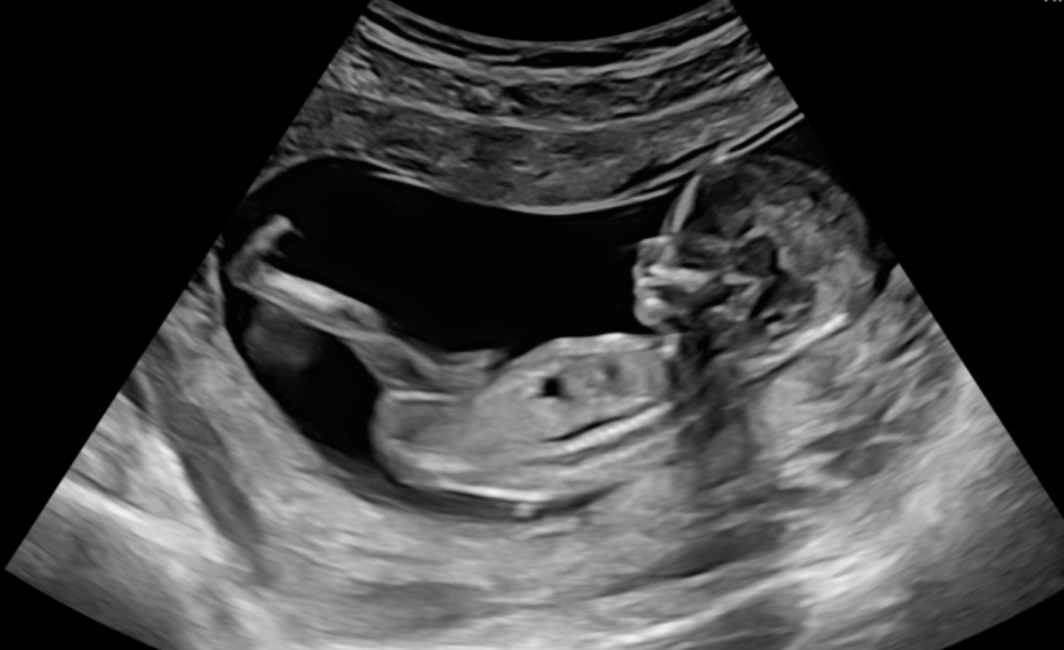 baby ultrasound at 12 weeks